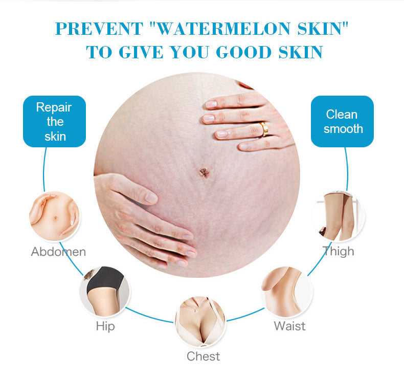 Anti-stretch Mark Cream