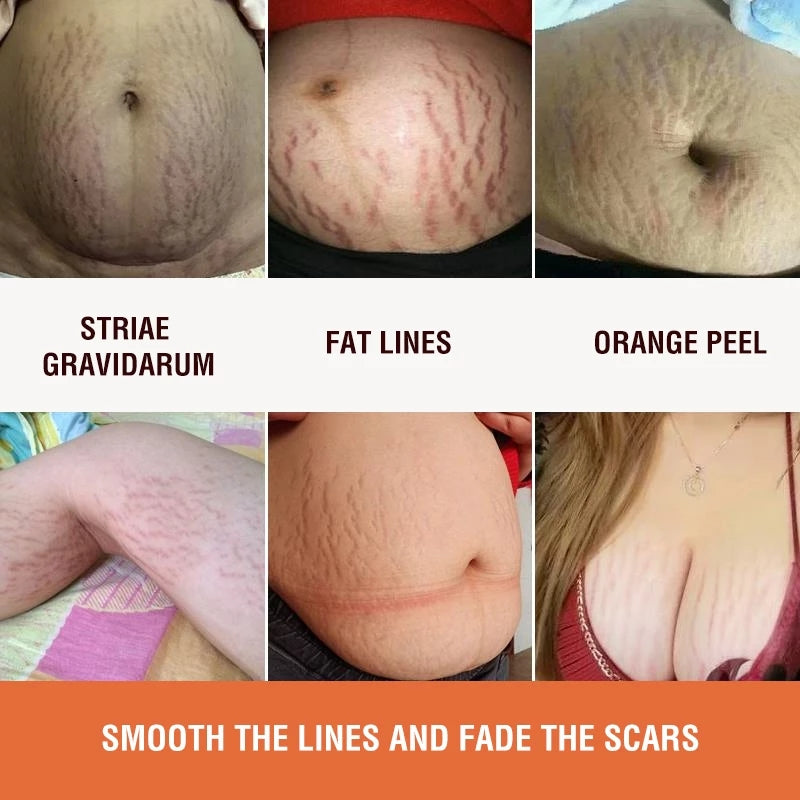 Anti-stretch Mark Cream
