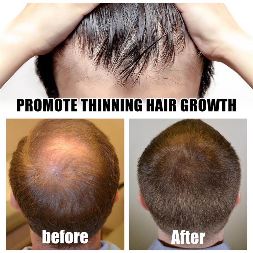 Derma Roller Microniddle Roller for Hair Growth