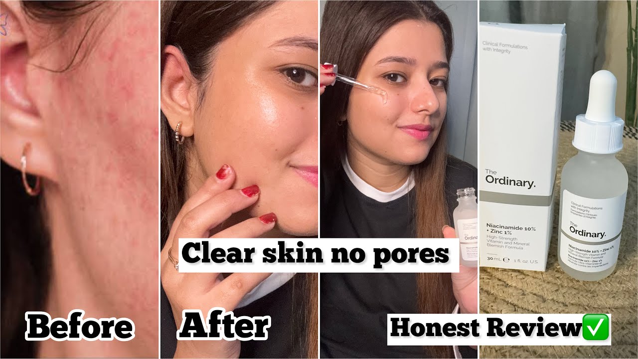 The Ordinary Niacinamide 10% + Zinc 1% Anti-Blemish Serum