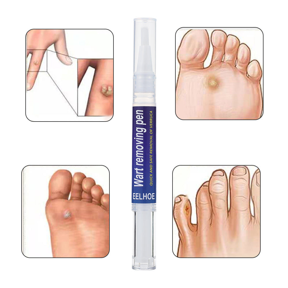 Wart Removing Pen