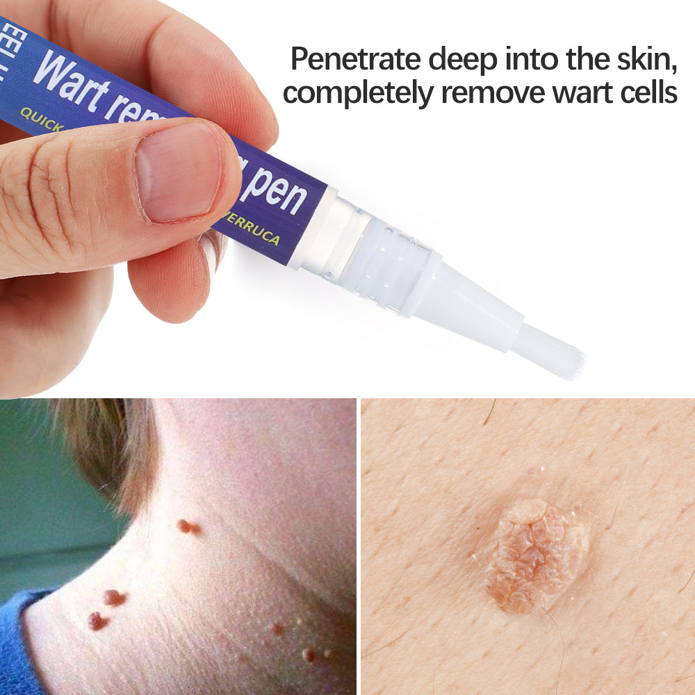 Wart Removing Pen