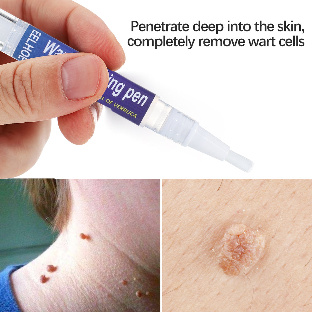 Wart Removing Pen