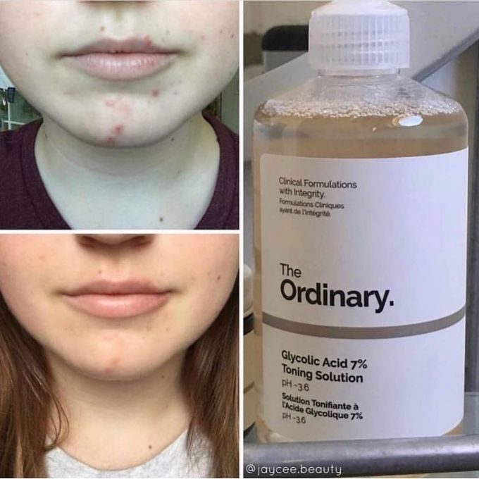 The Ordinary Glycolic Acid 7% Toning Solution