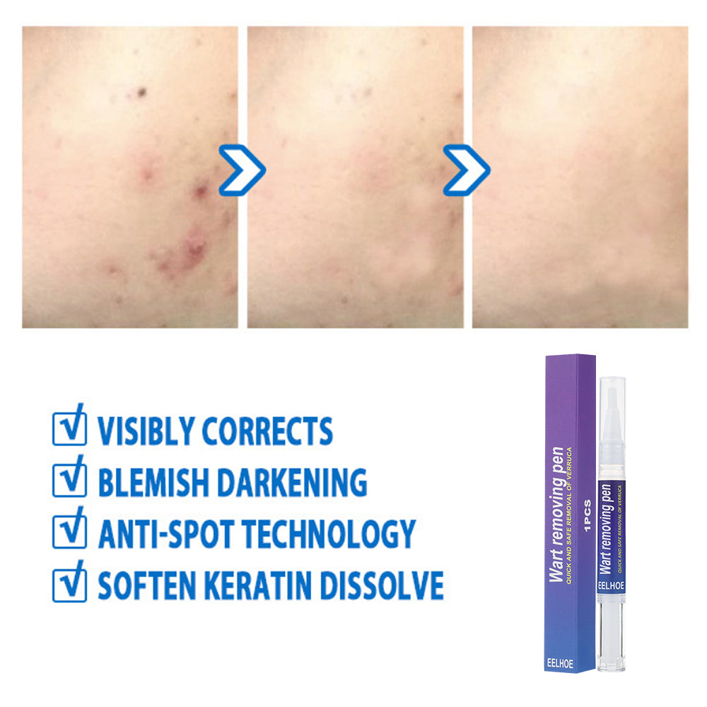 Wart Removing Pen