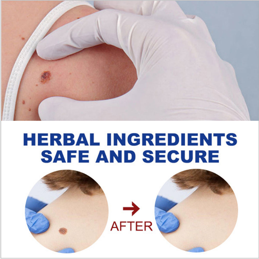 Wart Removing Pen
