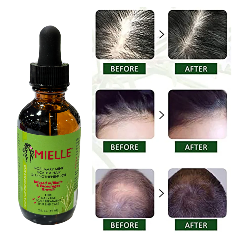পারফেক্ট কম্বো!-Mielle Rosemary Mint Hair Growth Oil + Derma Roller